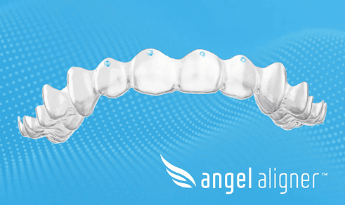 20261016Angelalign Has Already Replaced Torque Ridges with Upgraded “Pressure Points” in Europe.png